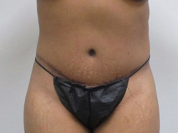 Abdominoplasty Before & After