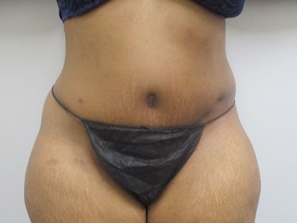 Abdominoplasty Before & After