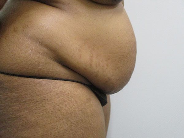 Abdominoplasty Before & After