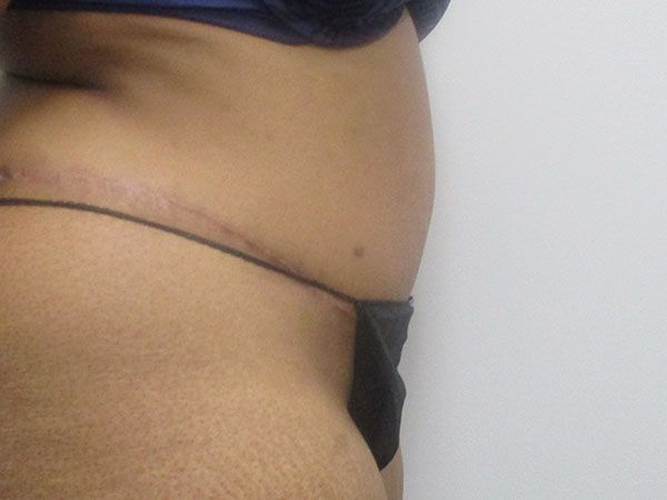 Abdominoplasty Before & After