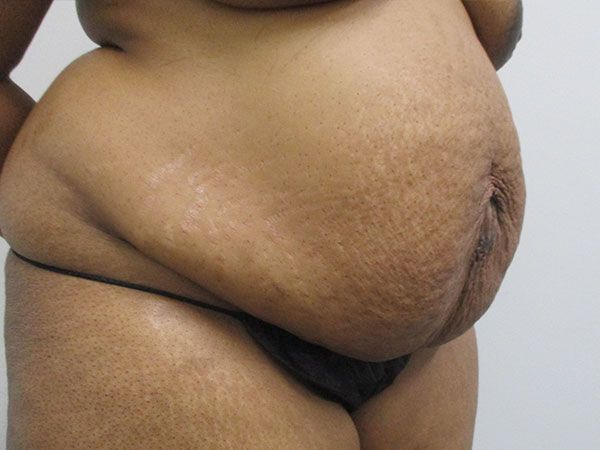 Abdominoplasty Before & After