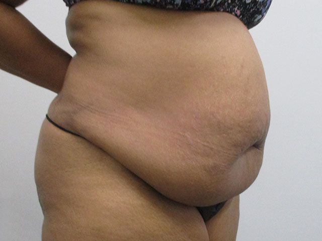 Abdominoplasty Before & After