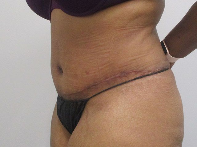 Abdominoplasty Before & After