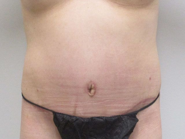 Abdominoplasty Before & After