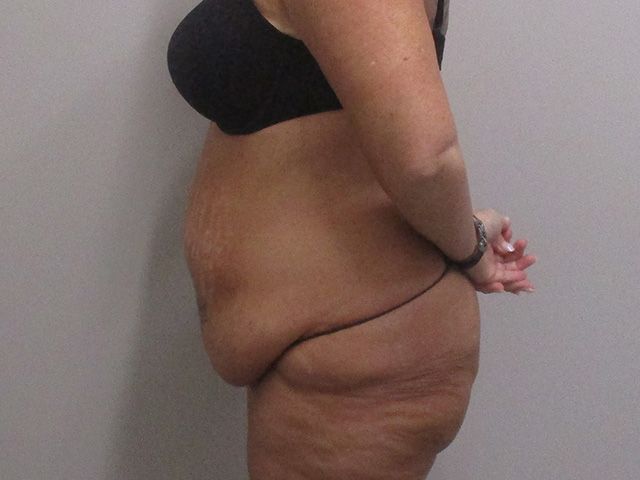 Abdominoplasty Before & After