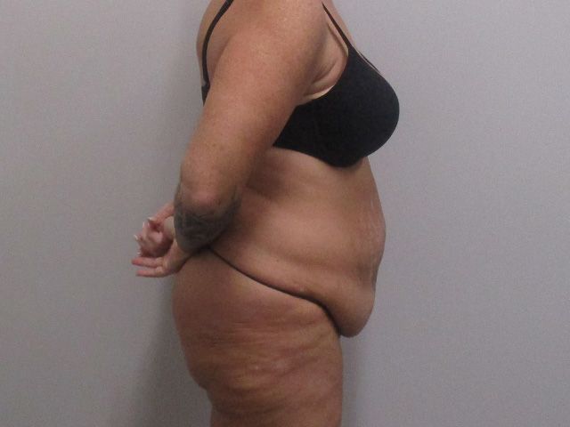 Abdominoplasty Before & After