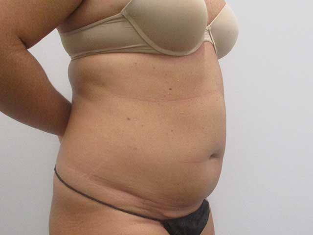Abdominoplasty Before & After