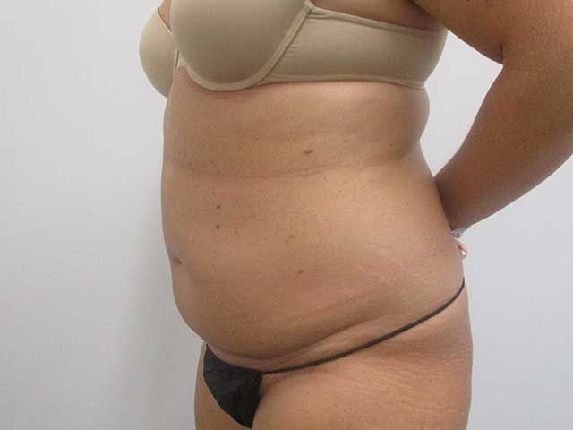 Abdominoplasty Before & After