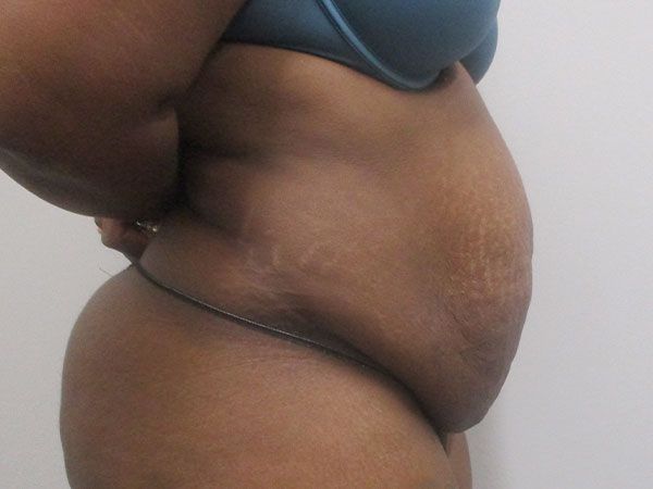 Abdominoplasty Before & After