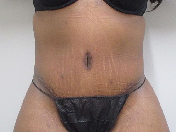 Abdominoplasty Before & After