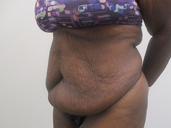 Abdominoplasty Before & After