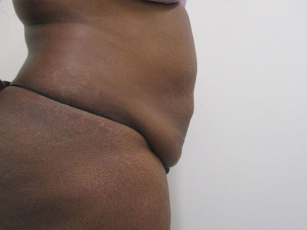 Abdominoplasty Before & After