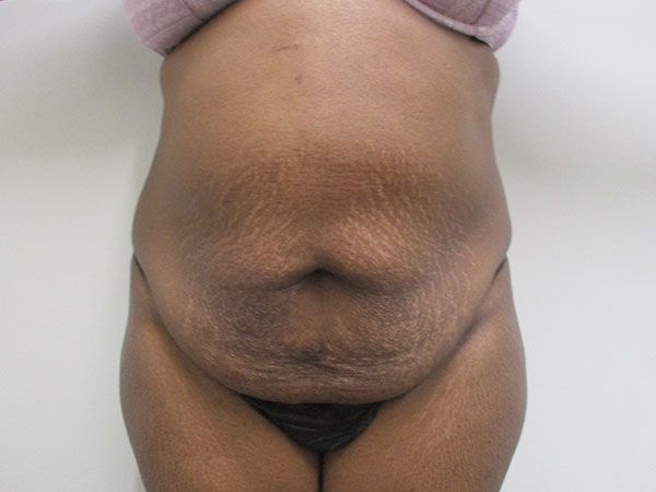 Abdominoplasty Before & After