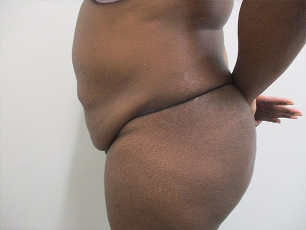 Abdominoplasty Before & After