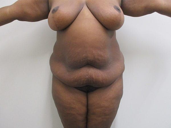 Abdominoplasty Before & After