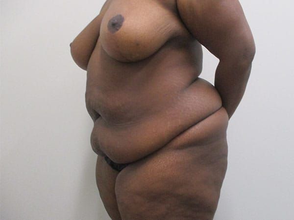 Abdominoplasty Before & After