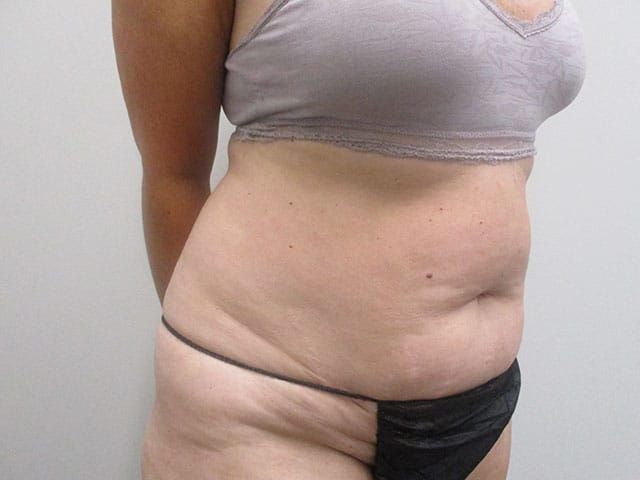 Abdominoplasty Before & After