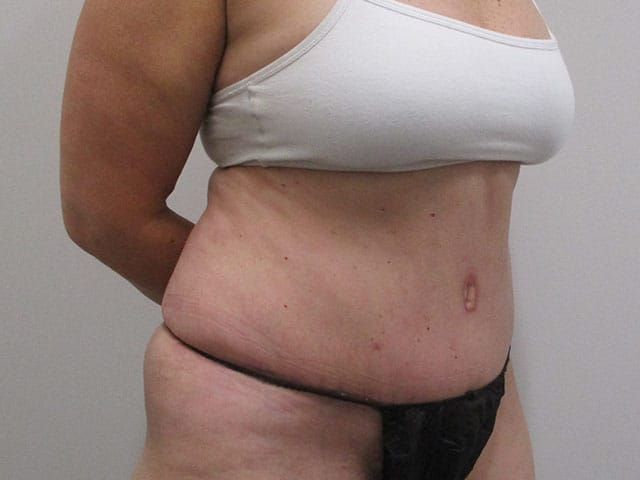 Abdominoplasty Before & After
