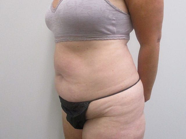 Abdominoplasty Before & After