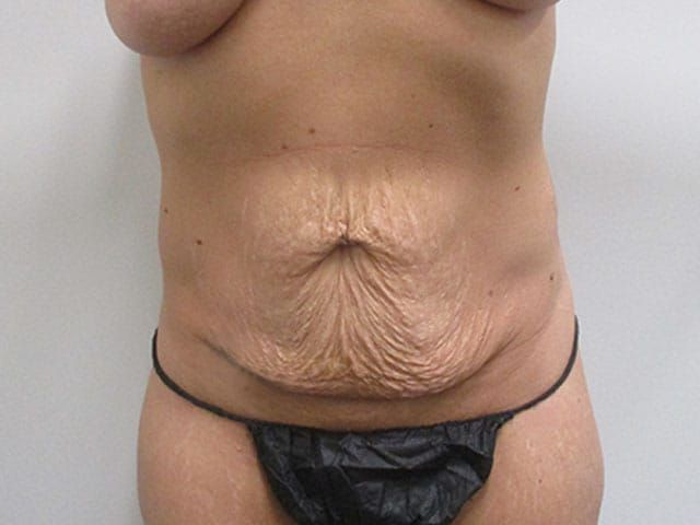 Abdominoplasty Before & After