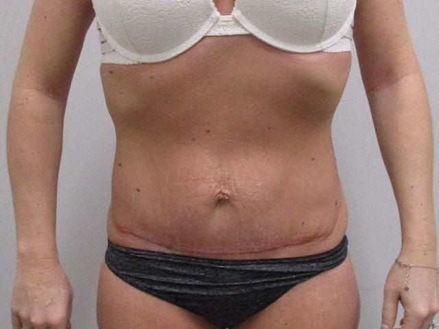 Abdominoplasty Before & After