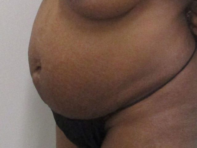 Abdominoplasty Before & After