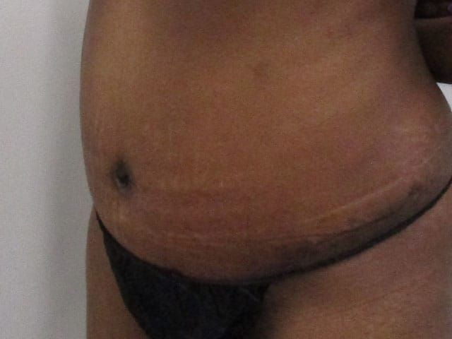 Abdominoplasty Before & After