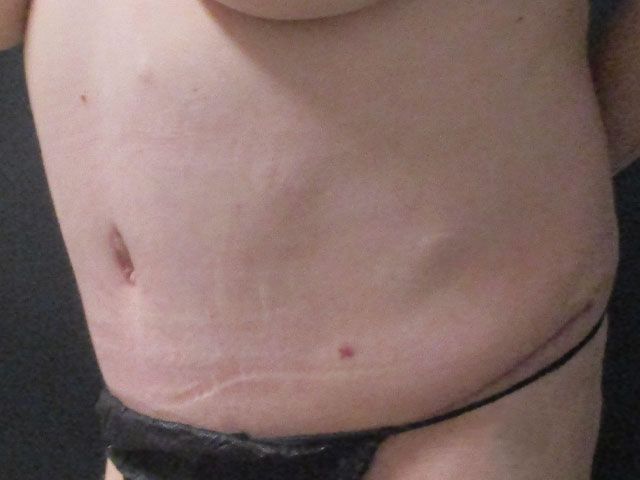 Abdominoplasty Before & After