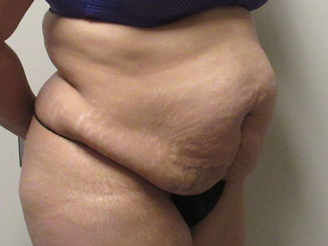 Abdominoplasty Before & After