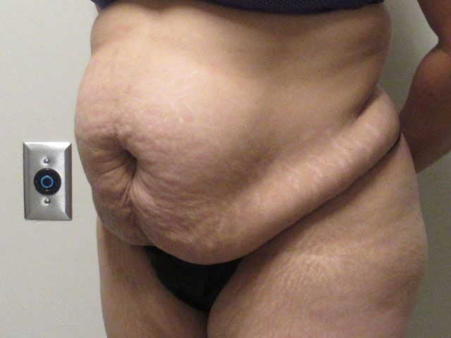Abdominoplasty Before & After