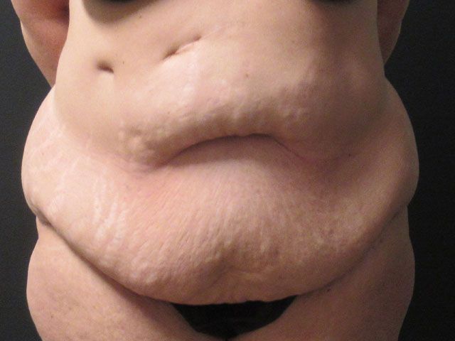 Abdominoplasty Before & After