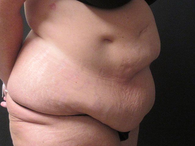 Abdominoplasty Before & After