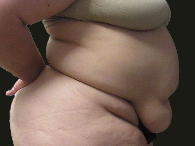 Abdominoplasty Before & After