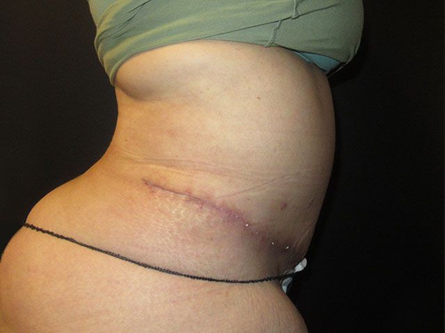 Abdominoplasty Before & After