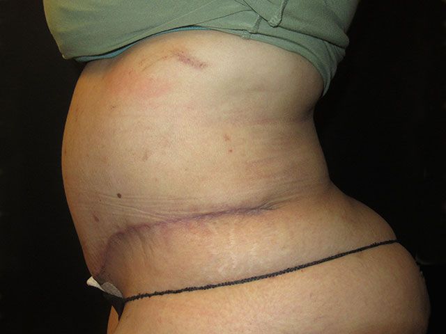 Abdominoplasty Before & After