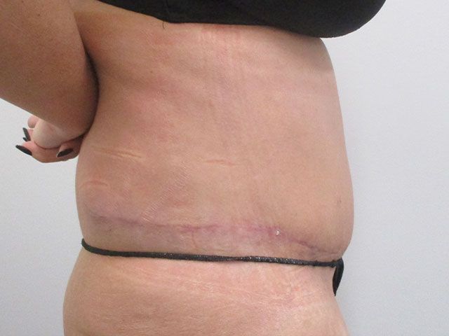 Abdominoplasty Before & After