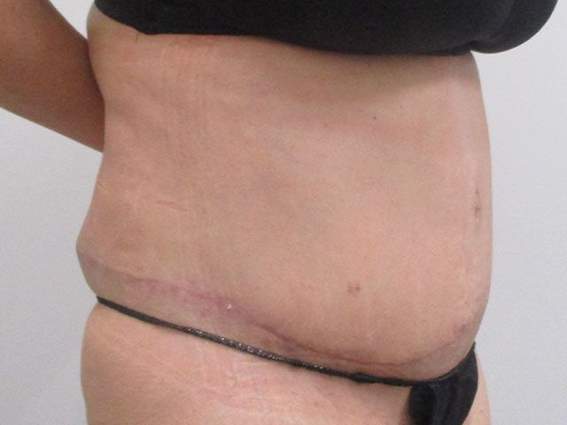 Abdominoplasty Before & After