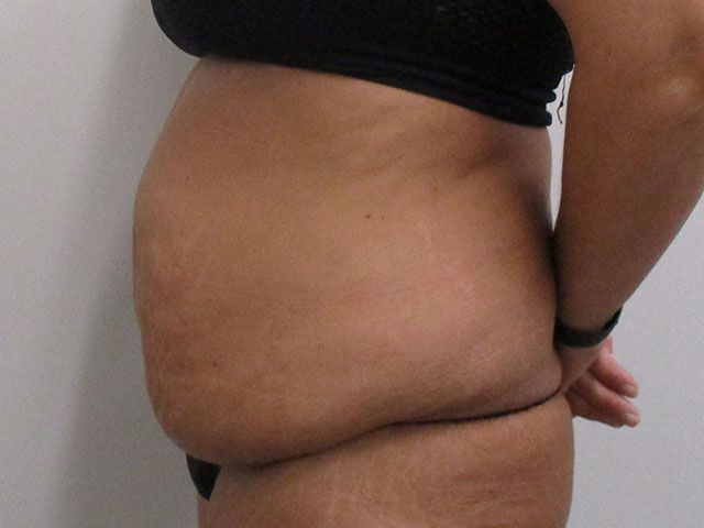Abdominoplasty Before & After
