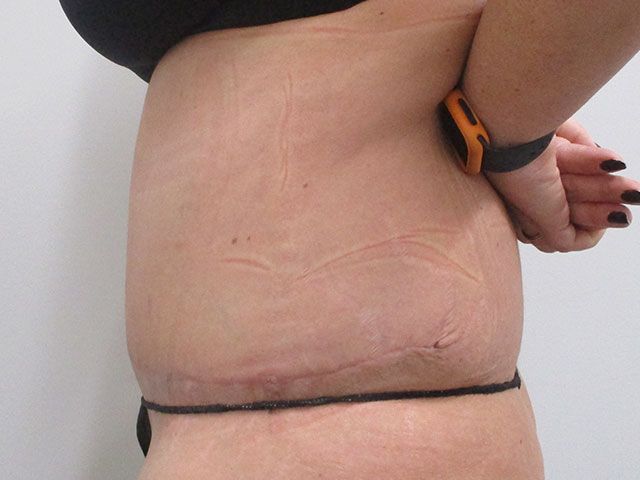 Abdominoplasty Before & After