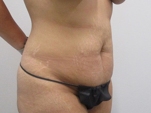 Abdominoplasty Before & After