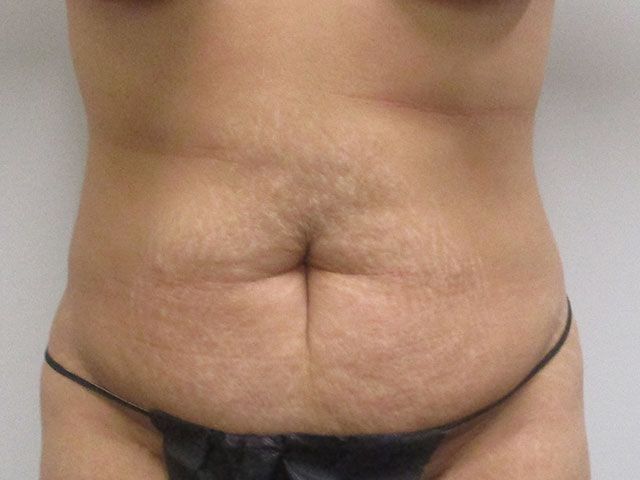 Abdominoplasty Before & After