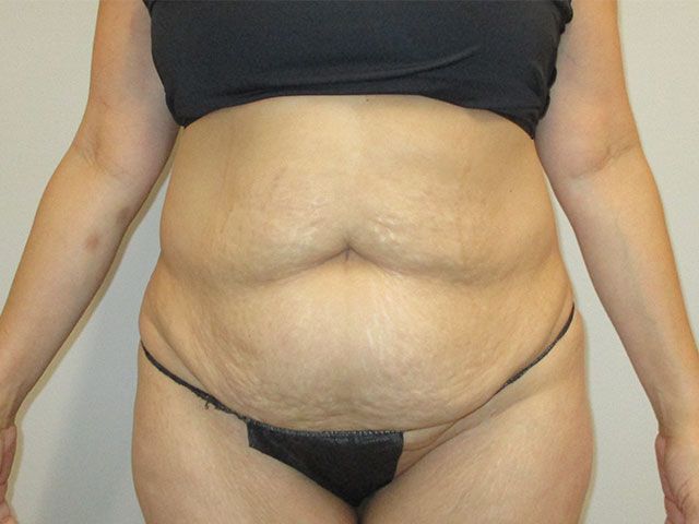 Abdominoplasty Before & After