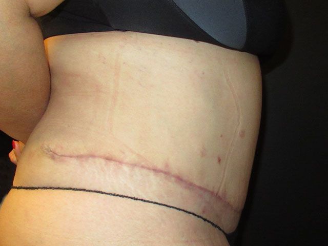 Abdominoplasty Before & After