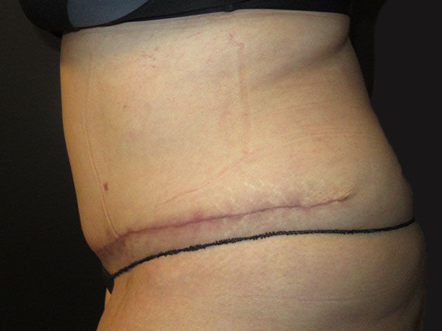 Abdominoplasty Before & After