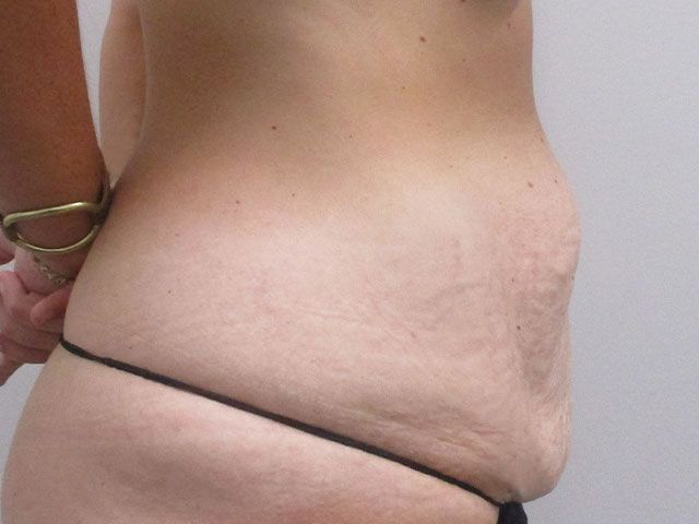Abdominoplasty Before & After