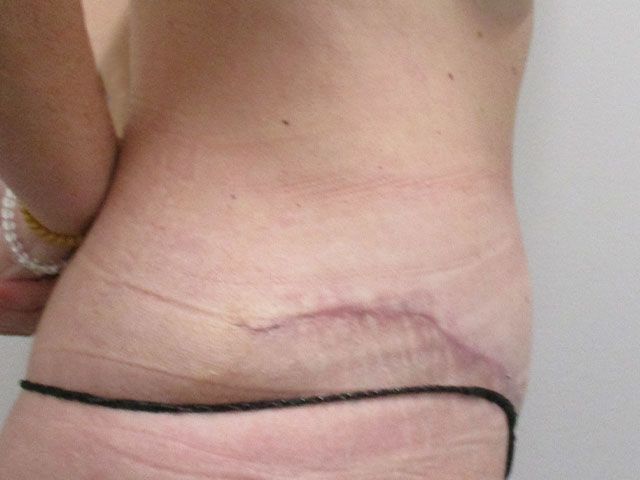 Abdominoplasty Before & After