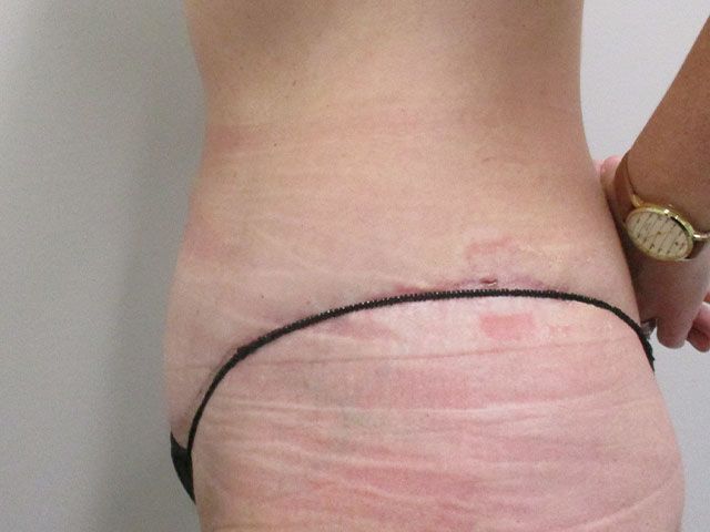 Abdominoplasty Before & After