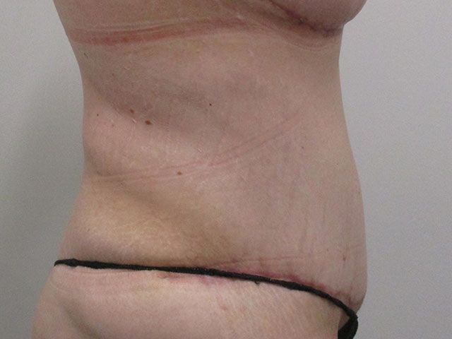 Abdominoplasty Before & After