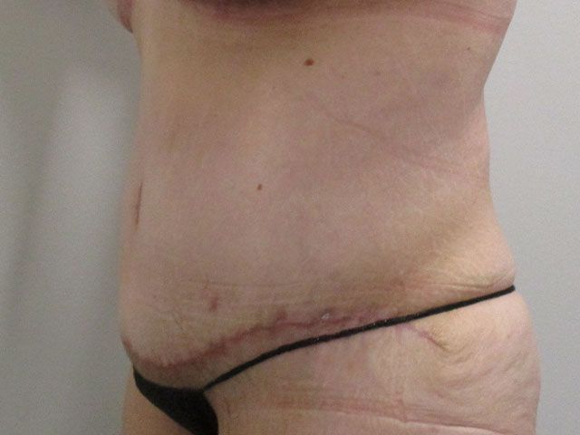 Abdominoplasty Before & After