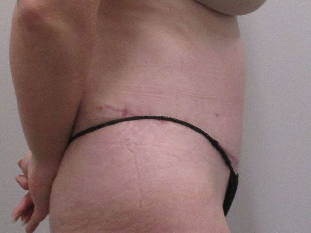 Abdominoplasty Before & After